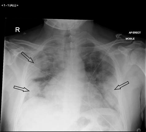 Chest Radiograph Pneumonia