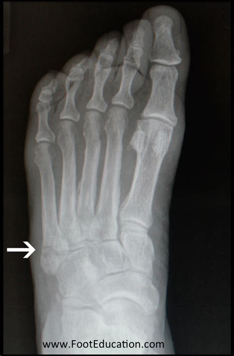 Th Metatarsal Avulsion Fracture FootEducation