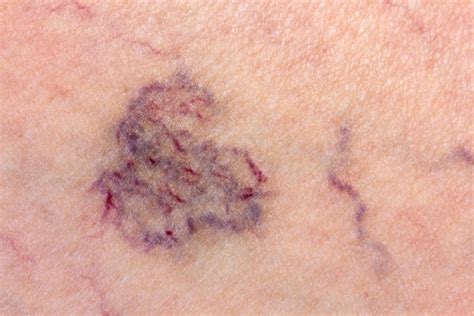 What Are The First Signs Of Phlebitis Archyde