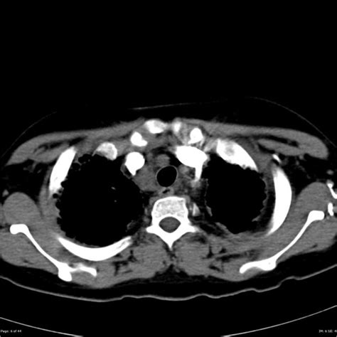 Down Syndrome Subpleural Cysts Radiology Case