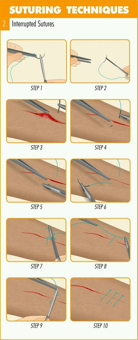 Suture Removal Times Chart