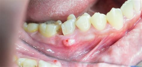 What Is A Dental Fistula News Dentagama