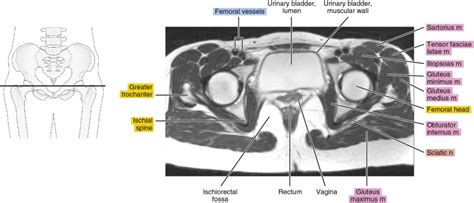 Mri Of The Female Pelvis Radiology Key