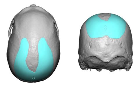 Parasagittal Skull Implant Designs Dr Barry Eppley Indianapolis