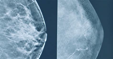 What Are Fibrocystic Breasts Solis Mammography