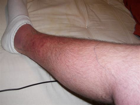 Day 4 Rash Gone From Upper Leg Only Located Around Calf A Flickr