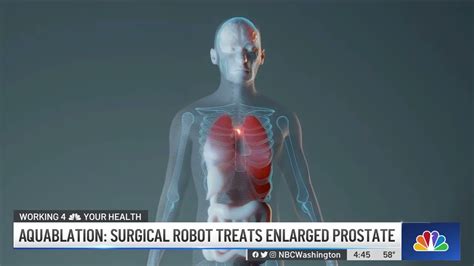 News At Aquablation Surgical Robot Treats Enlarged Prostate Youtube