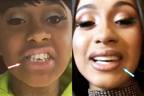 Cardi B Before And After Plastic Surgery Boobs Teeth Nose Hot Sex Picture