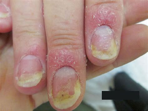 Psoriatic Nail Disease Photos Cantik