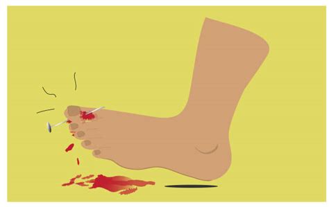 Ankle Sprain Cartoon Illustrations Royalty Free Vector Graphics And Clip