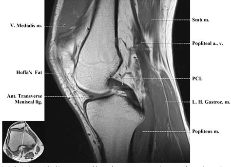 Figure 5 From Normal Mr Imaging Anatomy Of The Knee Semantic Scholar