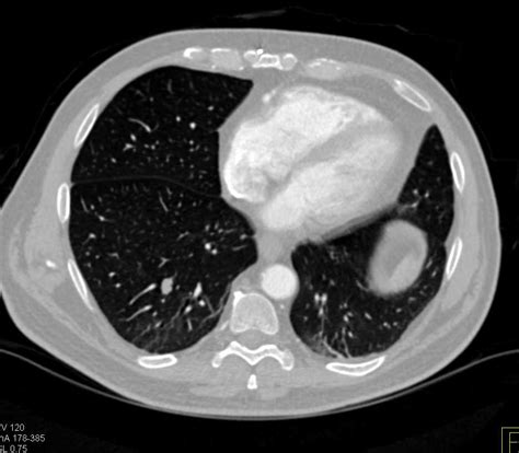 Lung Metastases From Pancreatic Adenocarcinoma Chest Case Studies