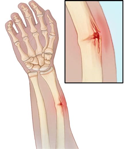 Buckle/Torus Fracture on Wrist/Arm