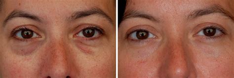Dark Circles Under Eyes Causes And How To Get Rid Fast Health Care