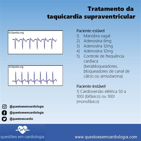Arritmias Taquicardia Sinusal Taquicardia Supraventricular The Best