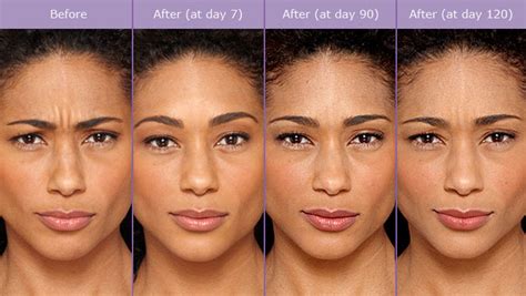 Botox is a neuromodulator that relaxes the muscles and once botox begins to take effect, usually three to five days after treatment, you injecting the frontalis muscle with botox to eliminate these lines must be done with caution, as the brows could. Botox® Injections in Connecticut | Re:Nu 180 MedSpa