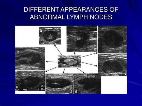 Axillary Lymph Nodes Ultrasound