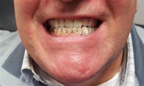 Before And After Photos Full And Partial Dentures Gallery Monticello Mn