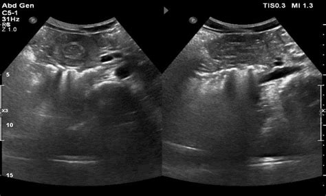 Abdominal Ultrasound Right Subcostal Hypoechoic Lesion Measuring