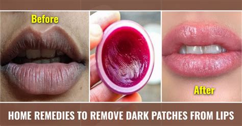 9 Home Remedies To Remove Dark Patches From Lips