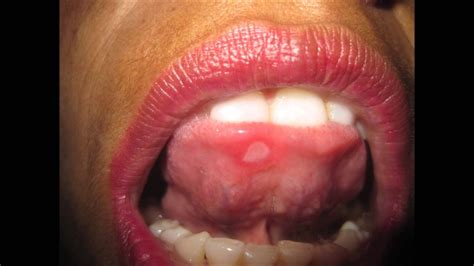 Ulcers At Tongue - YouTube