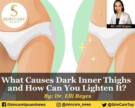 what causes dark inner thighs and how can you lighten it