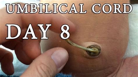Newborn Umbilical Cord Day 8 Home Birth Unassisted Natural Childbirth