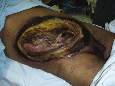 Surgery is necessary for definitive diagnosis and excision of necrotic tissue. Fournier's gangrene and its emergency management ...