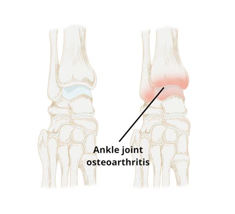 Ankle Osteoarthritis Circle Integrated Care