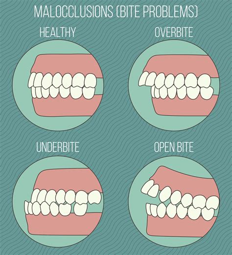 What Is Malocclusion And How Does It Affect Your Oral Health Mclean