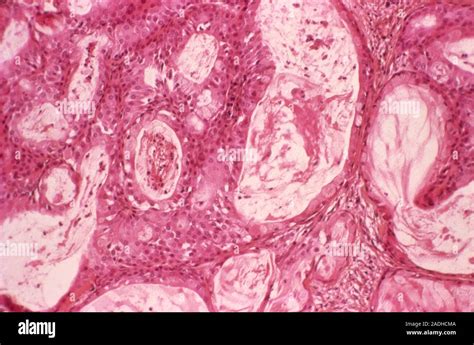 Salivary Gland Cancer Light Micrograph Of A Section Through An