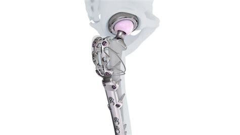 Variable Angle Lcp™ Periprosthetic Proximal Femur Plating System 354