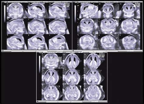 Normal Brain At 17 Weeks Tomographic Ultrasound Imaging Of Sagittal