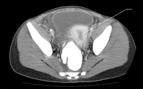 Ct Scan Of The Abdomen And Pelvis With Intravenous And Open I