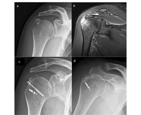 Case 2 Radiological Appearance Of A Greater Tuberosity Fracture