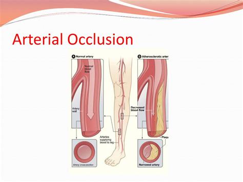 Ppt Arterial Diseases Powerpoint Presentation Free Download Id2378936