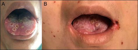 Photographs Of A Patient S Tongue Showing Ulcerating Lesions Likely Download Scientific