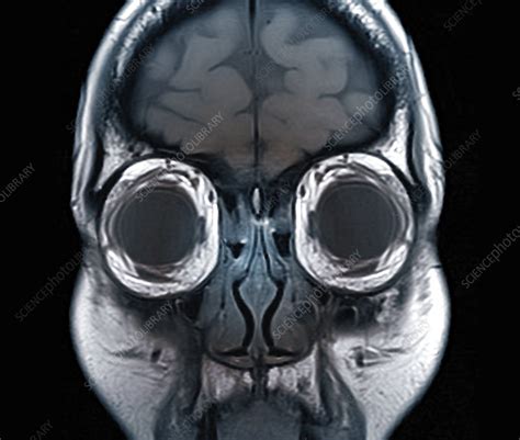 Eye Anatomy And Muscles Mri Scan Stock Image C0337448 Science