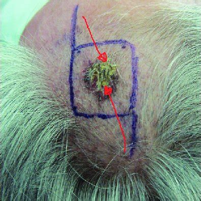 A 70yearold Male Patient With Basal Cell Carcinoma Of Scalp A