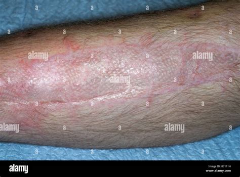 Shrapnel Wound Hi Res Stock Photography And Images Alamy