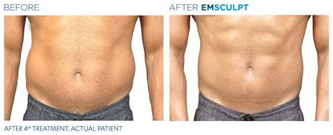 Emsculpt Before And After Man Cosmetic Dermatology Manhattan Beach