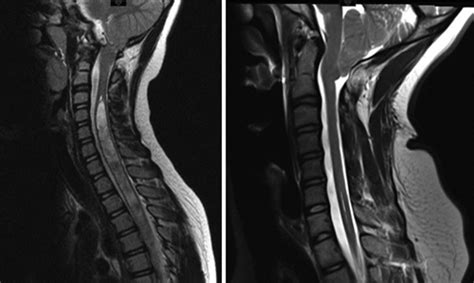 T2 Weighted Sagittal Mr Images Of Cervical Spine Obtained In A Child