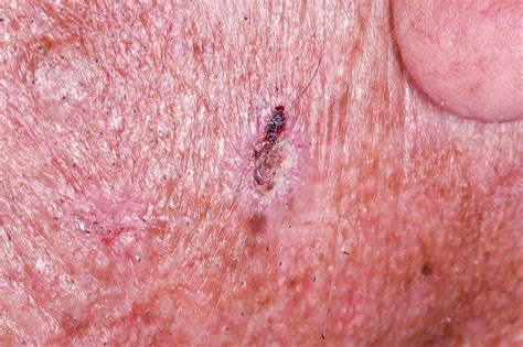 Basal Cell Carcinoma Skin Cancer Stock Image C0345442 Science