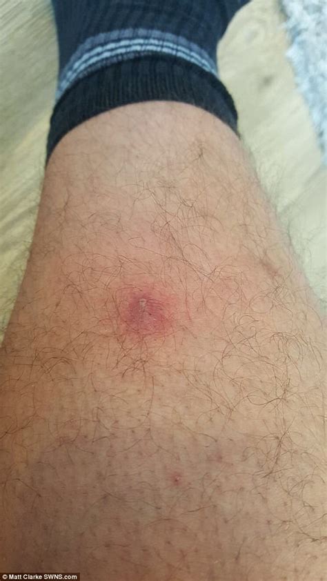 Squaddie Bitten By Spider Left With Gaping Hole In His Leg Daily Mail Online