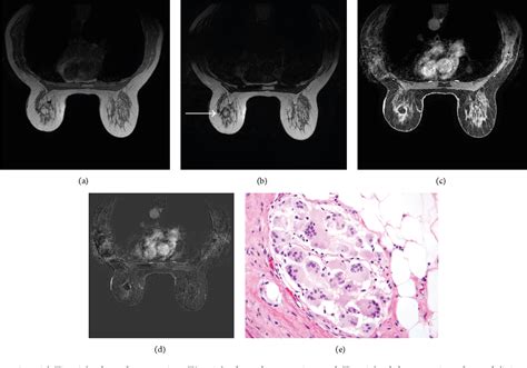 Figure 5 From Fat Necrosis Of The Breast A Pictorial Review Of The