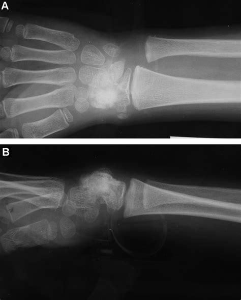 Case 1 Four Year Old Girl A Coronal Preoperative Plain Radiograph Of