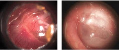 A And B Otoscopic View In Patients With A Left Acute Otitis Media