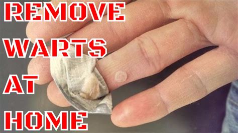 Trees help to remove carbon dioxide from the atmosphere. WART REMOVAL - HOW TO REMOVE WARTS AT HOME - YouTube