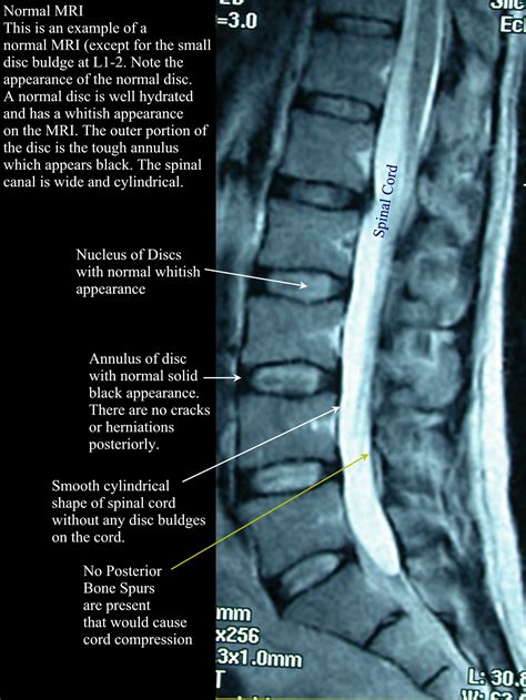 Imaging And The Lumbar Spine What Does It Tell Us — Amp Healthcare