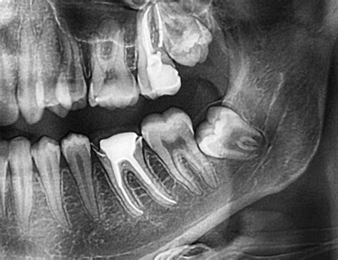 7 Common Postoperative Complications After Wisdom Teeth Removal